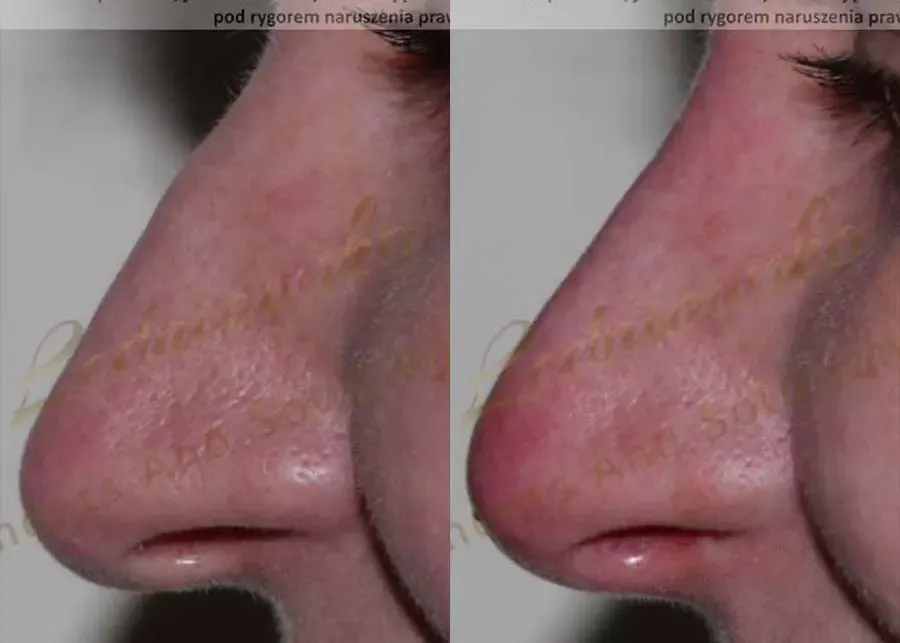 zabieg korekcji zmiany kształtu nosa